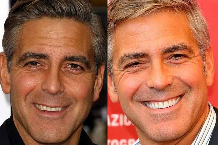 بازیگران هالیوودی که با تغییر لبخندشان مسیر حرفهای شان عوض شد 2 بازیگران هالیوودی که با تغییر لبخند