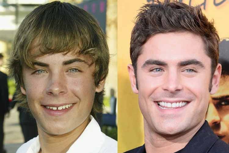 بازیگران هالیوودی که با تغییر لبخندشان مسیر حرفهای شان عوض شد 3 هزینههای واقعی لبخند بازیگران هالیوودی